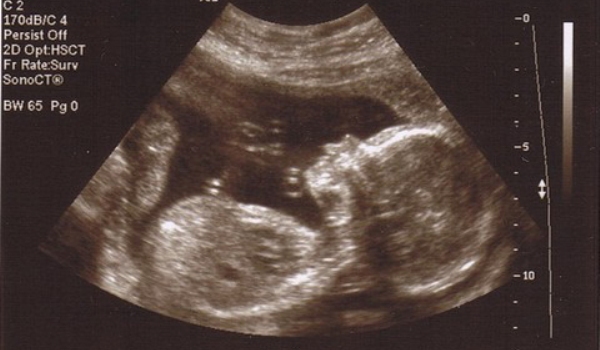 Почему на 21 недели. Пол ребенка на УЗИ. Пол на УЗИ. Снимки УЗИ на 20 неделе беременности.