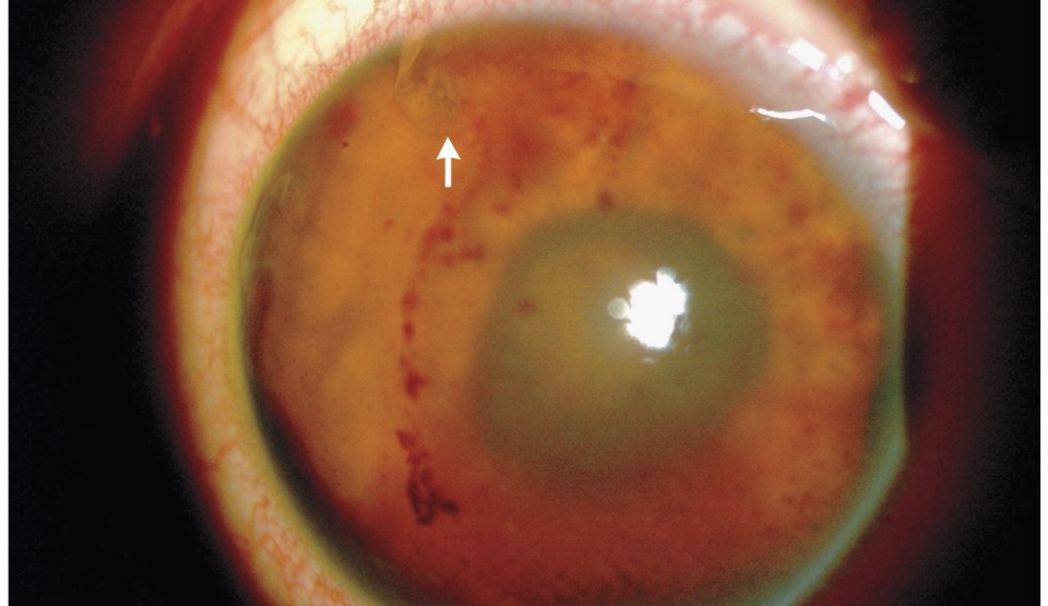 paraziti in ochi viermii pentru copii sunt tratati pentru tiroida