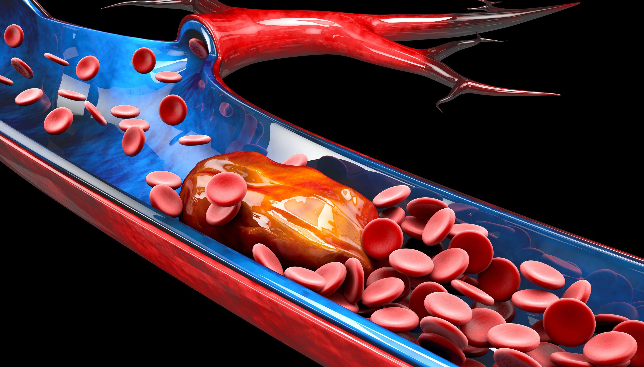 Возникновение тромбов. Тромбоз кровеносных сосудов. Образование тромбов в артериях.