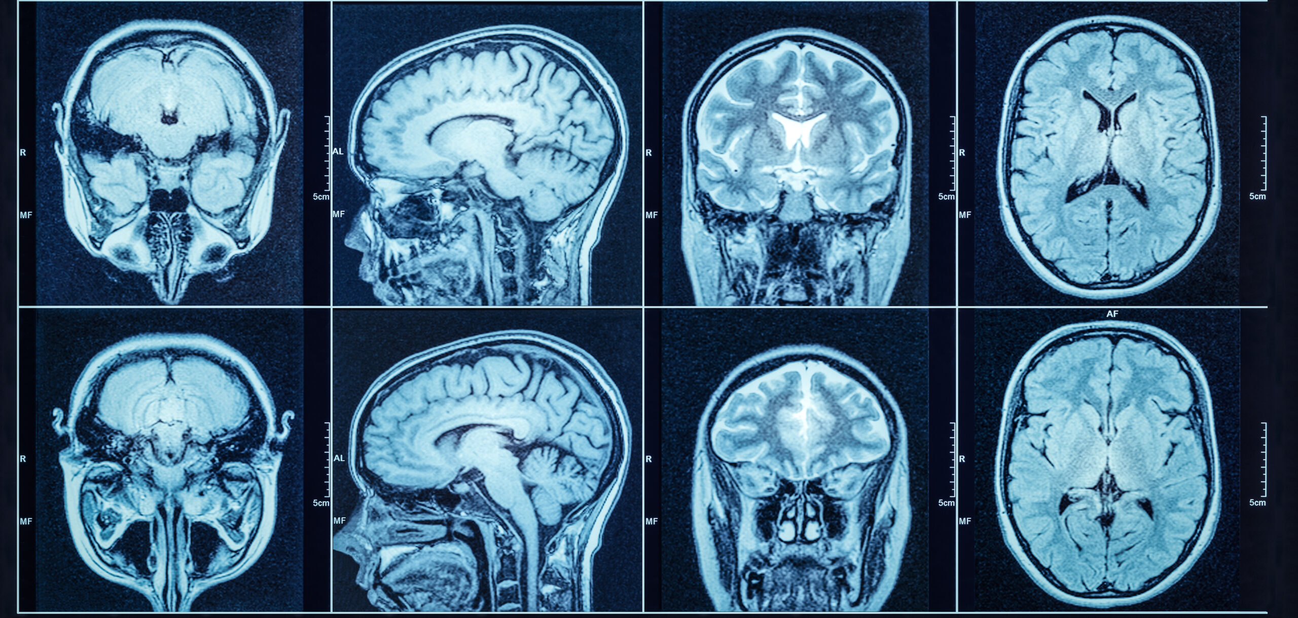 Мрт головного мозга в центре. Ликворография головного мозга магнитно-резонансная. Кт томограмма головного мозга. Компьютерная томография кт головного мозга. Магнитно резонансные томограммы головного мозга.