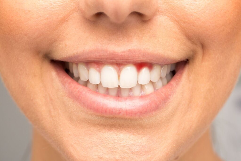 Sângerarea gingiilor ar putea fi un semn precoce al unei afecțiuni mult mai grave