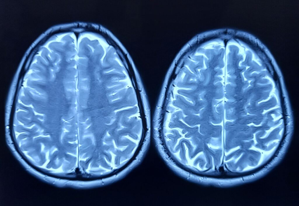 Depresia ar putea afecta capacitatea creierului de a genera noi neuroni