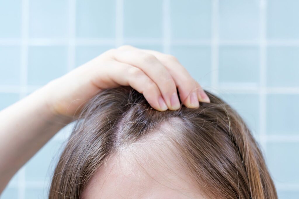 Un medicament comun pentru artrită ar putea stimula regenerarea părului la pacienții cu alopecie