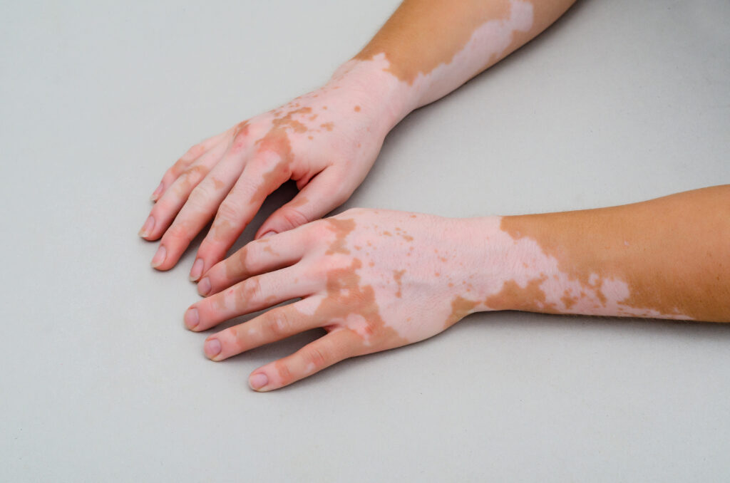 Un medicament pentru persoanele cu vitiligo a avut rezultate promițătoare într-un studiu clinic