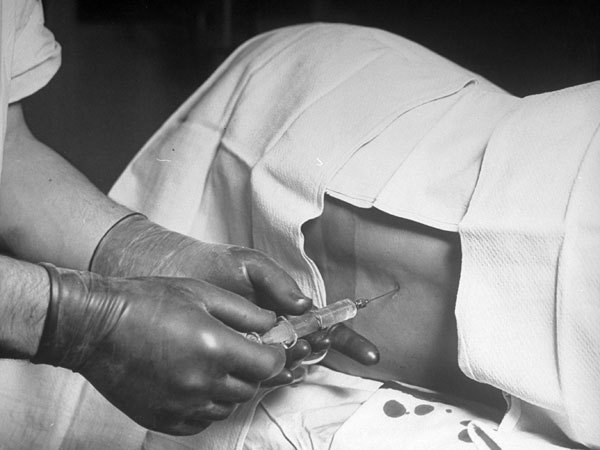 August Bier a inventat anestezia spinală, numită şi rahi-anestezie