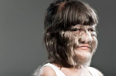 Supatra Sasuphan, cea mai păroasă adolescentă din lume