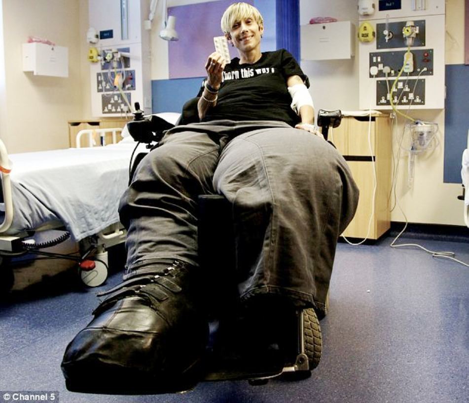 Un nou tratament a dus la o uşoară descreştere în dimensiuni a picioarelor lui Mandy Sellars.