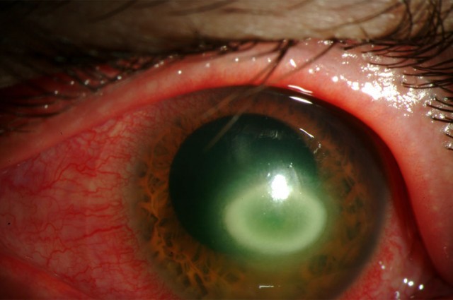 Ochi distrus de Acanthamoebic keratitis