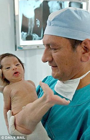 Milagros Cerron a fost operată şi medicii au reuşit să-i separe picioarele