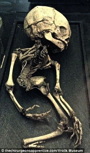 Schelet cu malformaţie, aflat în muzeul Vrolik din Amsterdam