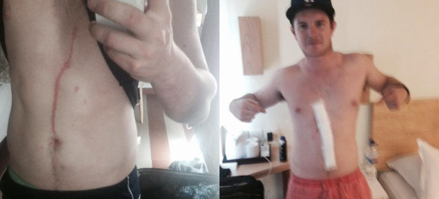 Cicatricea pe sub care s-ar fi târât păianjenul