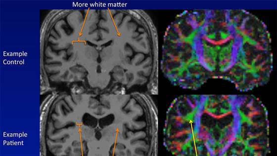 Creierul unei persoane sănătoase (sus) în comparaţie cu al unui bolnav (jos)