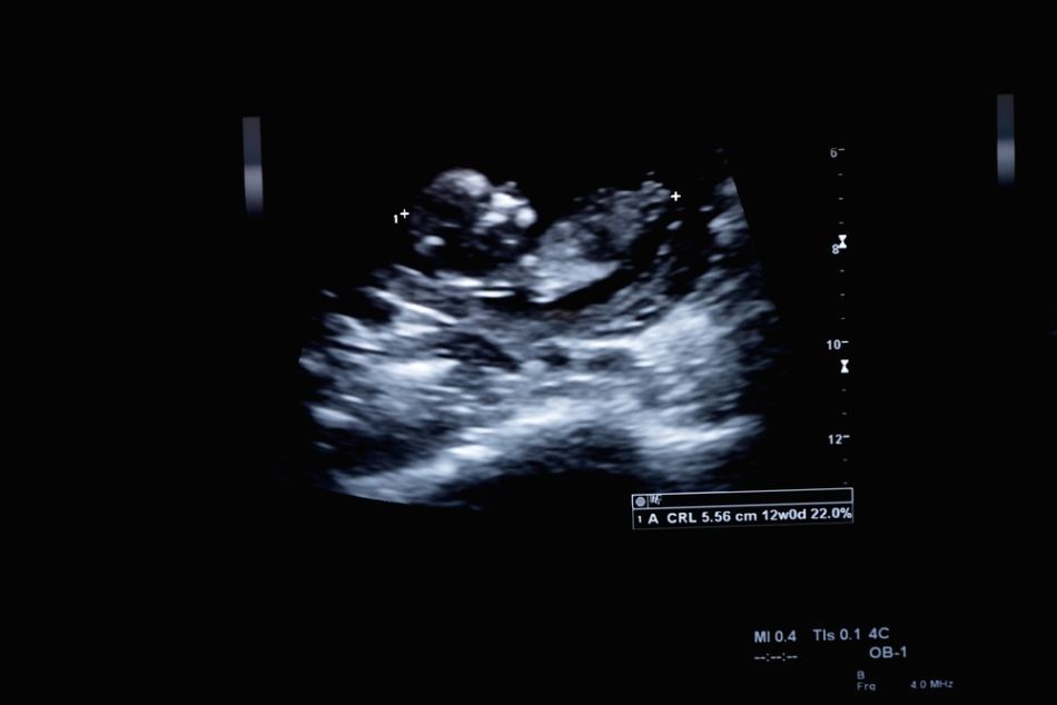 Ecografia unui fetus uman de trei luni de zile.