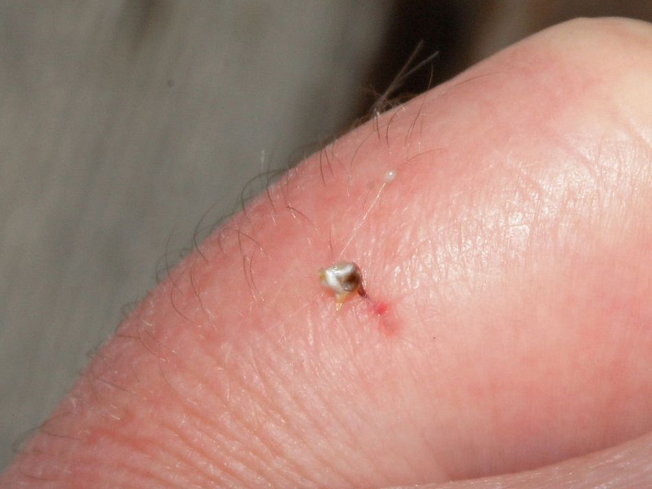 urma intepaturii unui ac de albina